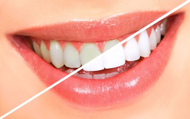 Quan tâm nhiều đến việc vệ sinh răng miệng, tẩy trắng răng trươc ngày cưới